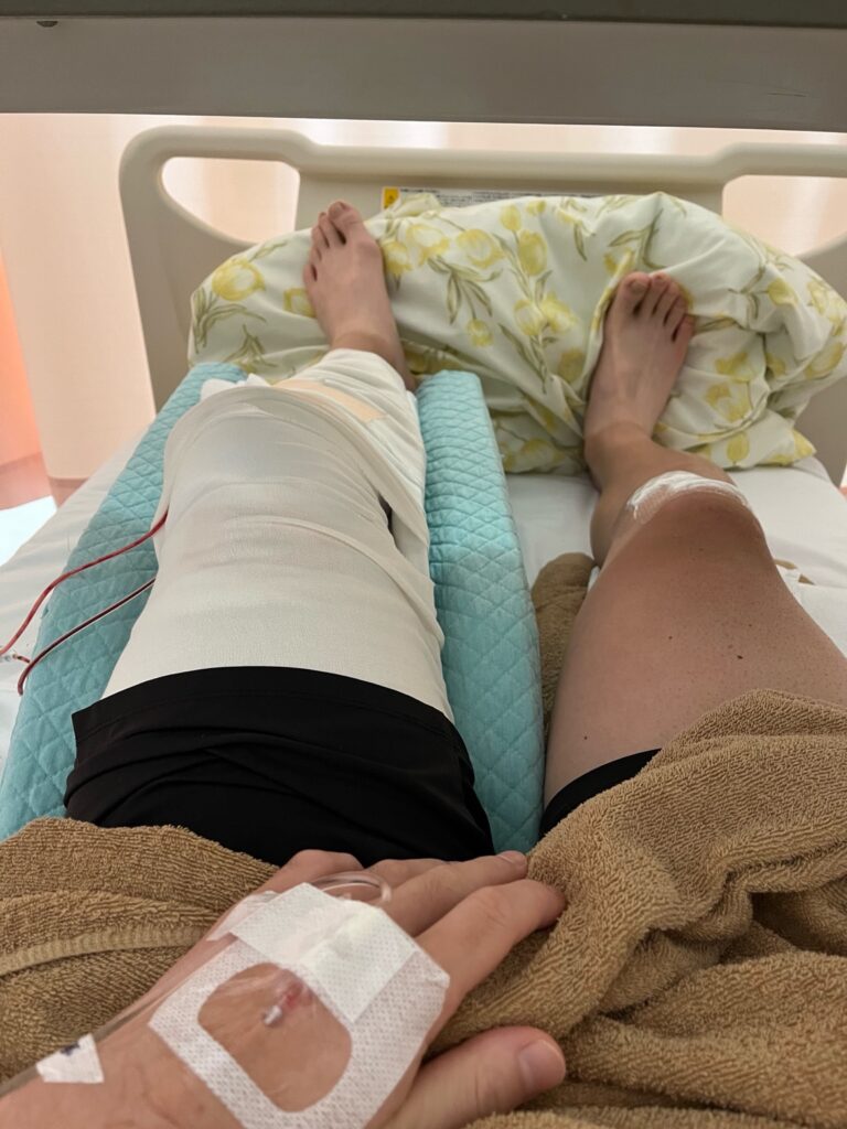 前十字靭帯再建術後の左膝と抜釘後の右膝の比較