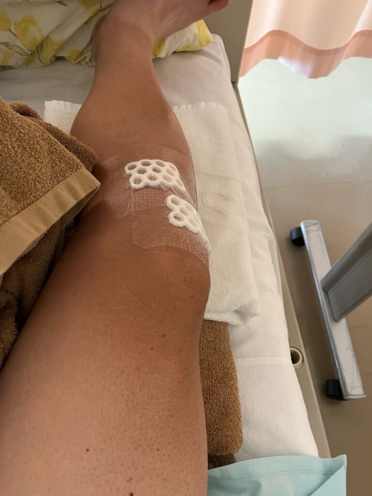 右膝の抜釘後のテープ固定の様子