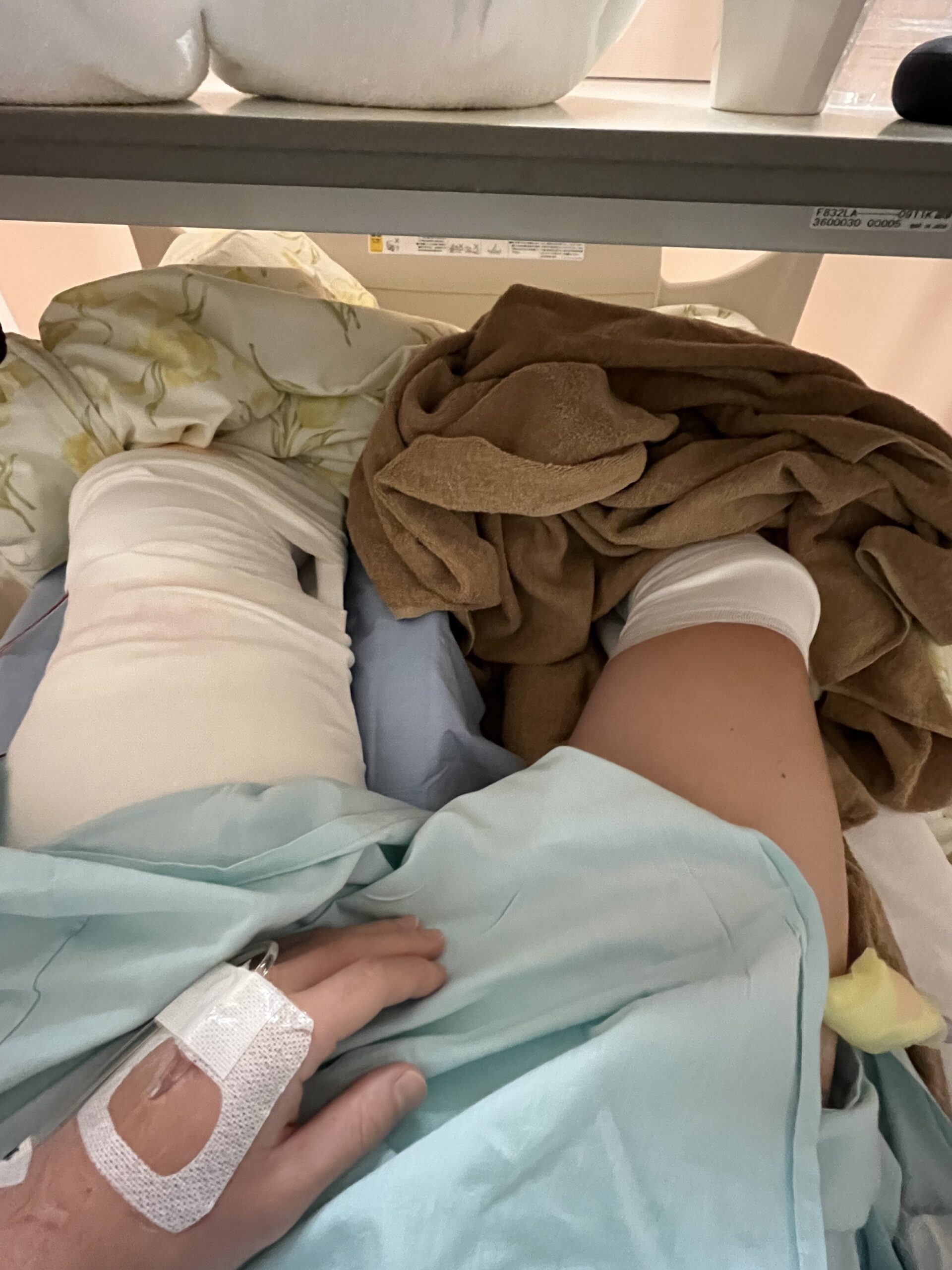 前十字靭帯再建術と半月板縫合手術後の膝