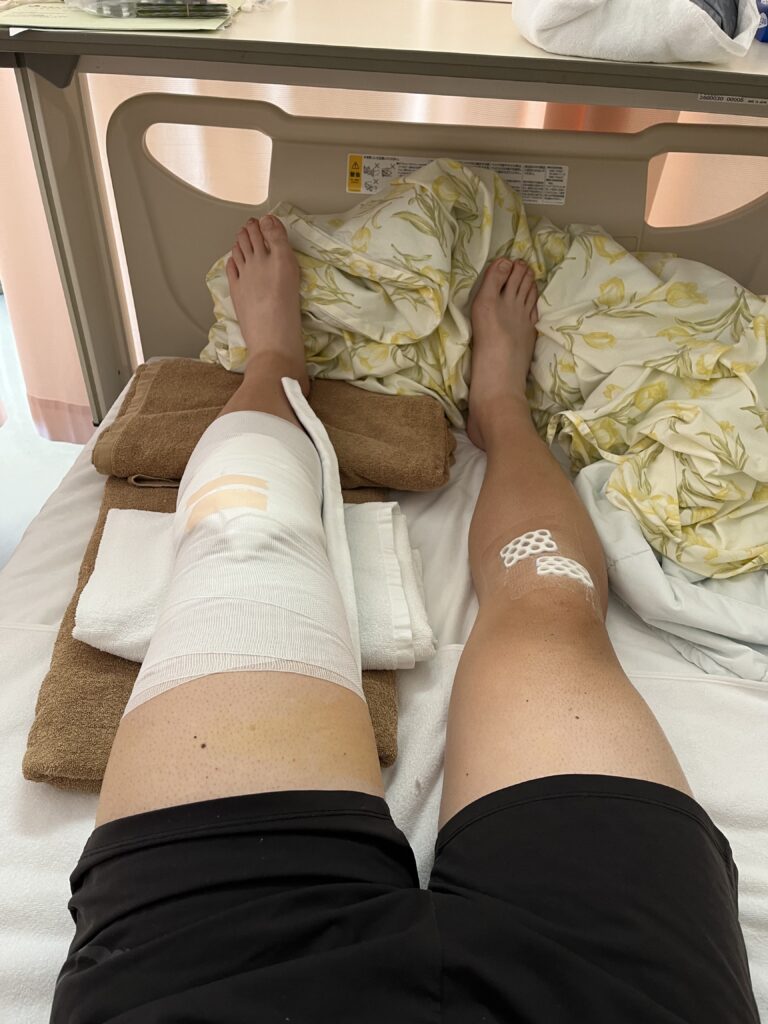術後3日目、左膝のドレーンが外れた様子
