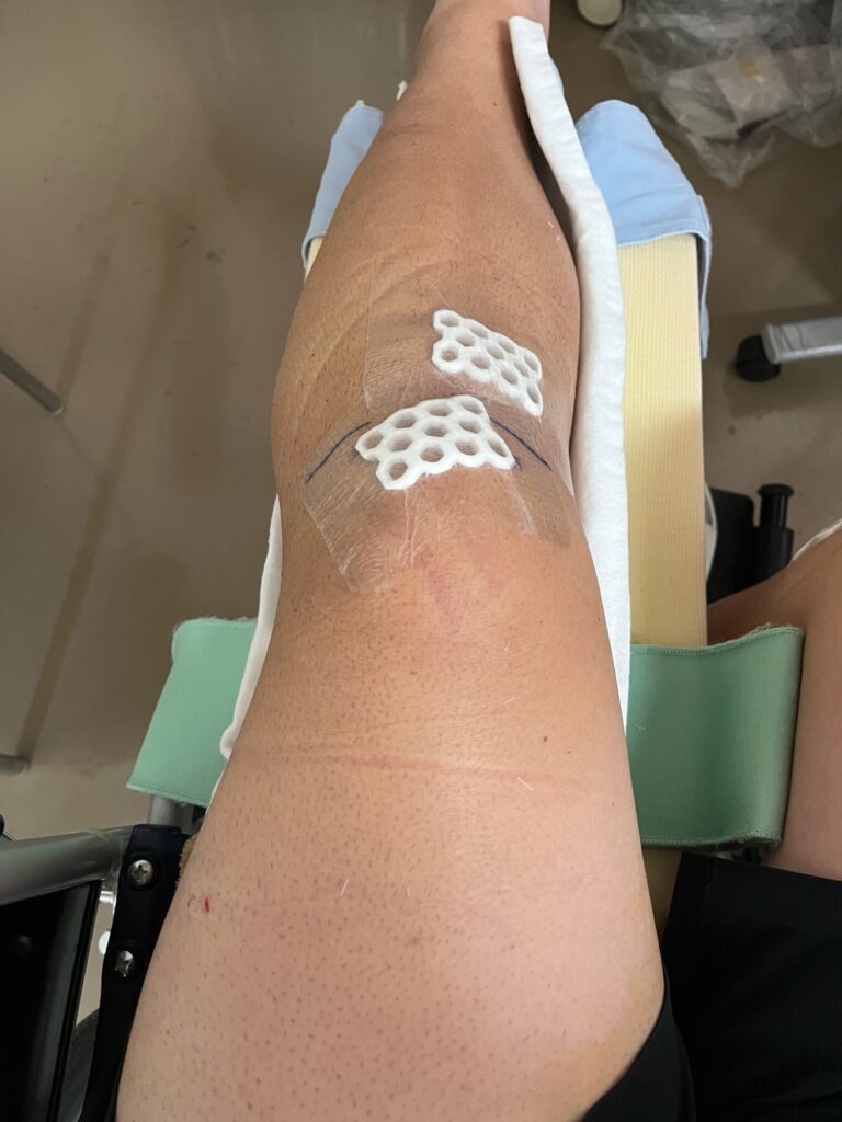 前十字靭帯再建術後4日目、包帯が外れテープのみになった左膝。