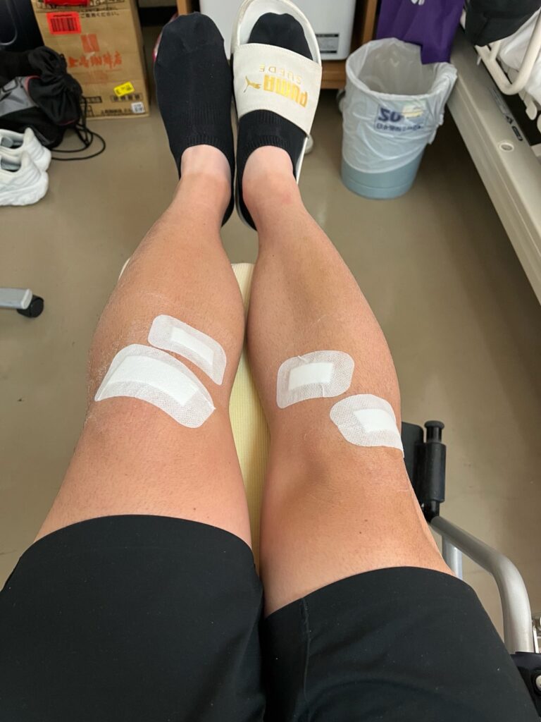 抜糸後の膝の様子（傷口保護テープあり）