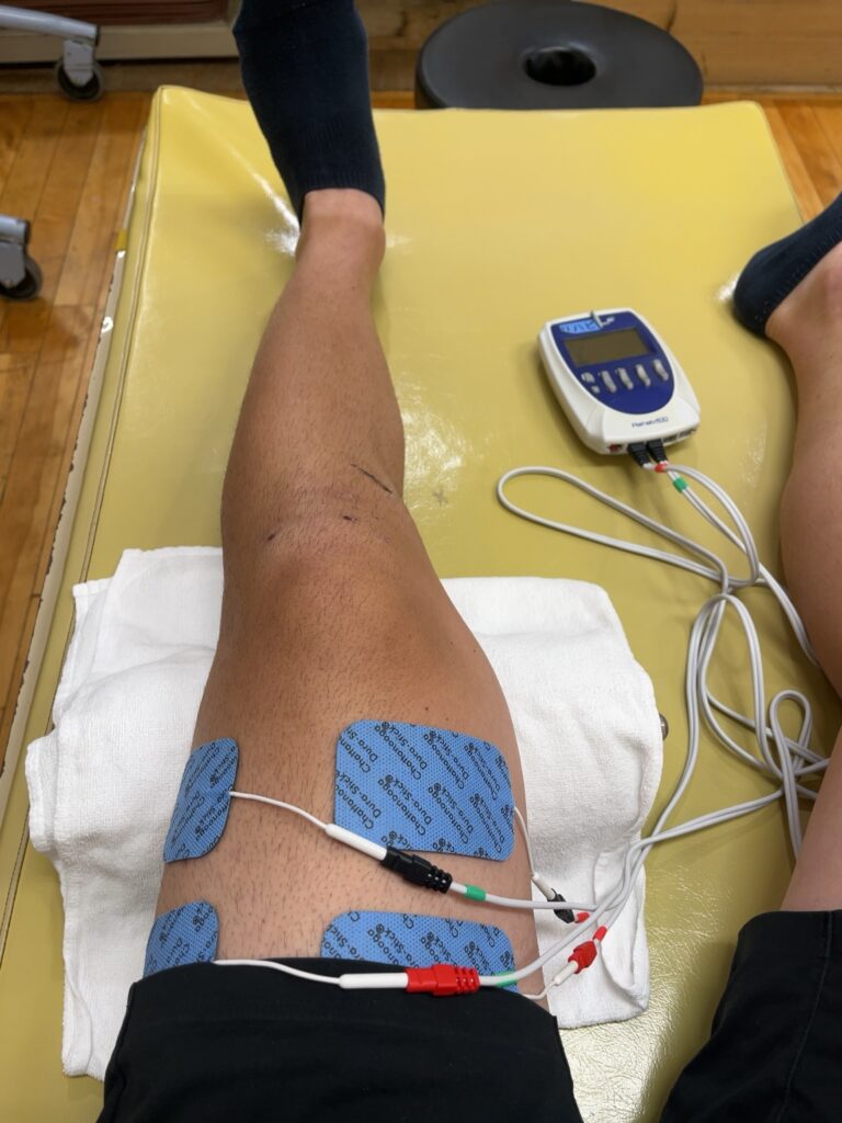 ACL術後14日目 リハビリ風景（電気刺激による大腿四頭筋トレーニング中）