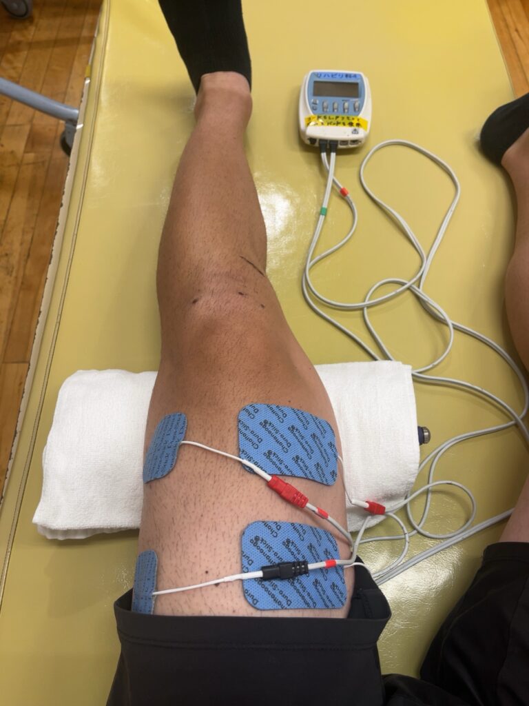 ACL術後13日目のリハビリ（電気治療で大腿部に刺激を与えている様子）