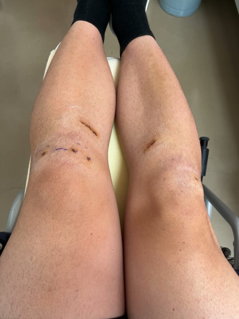 ACL術後12日目の膝の様子(抜糸後テープが外れた様子)