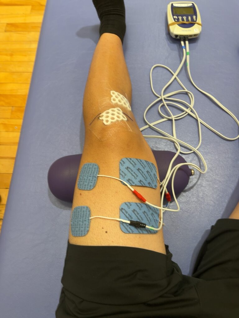 術後5日目のリハビリで、大腿四頭筋に電気刺激を流しながら膝を伸ばすトレーニングを行う様子(前十字靭帯再建術・半月板縫合手術後)